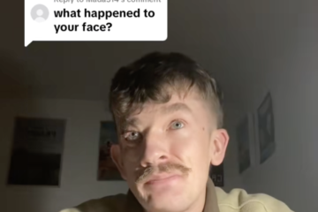 What Happened to Johnny's Face on The Apprentice